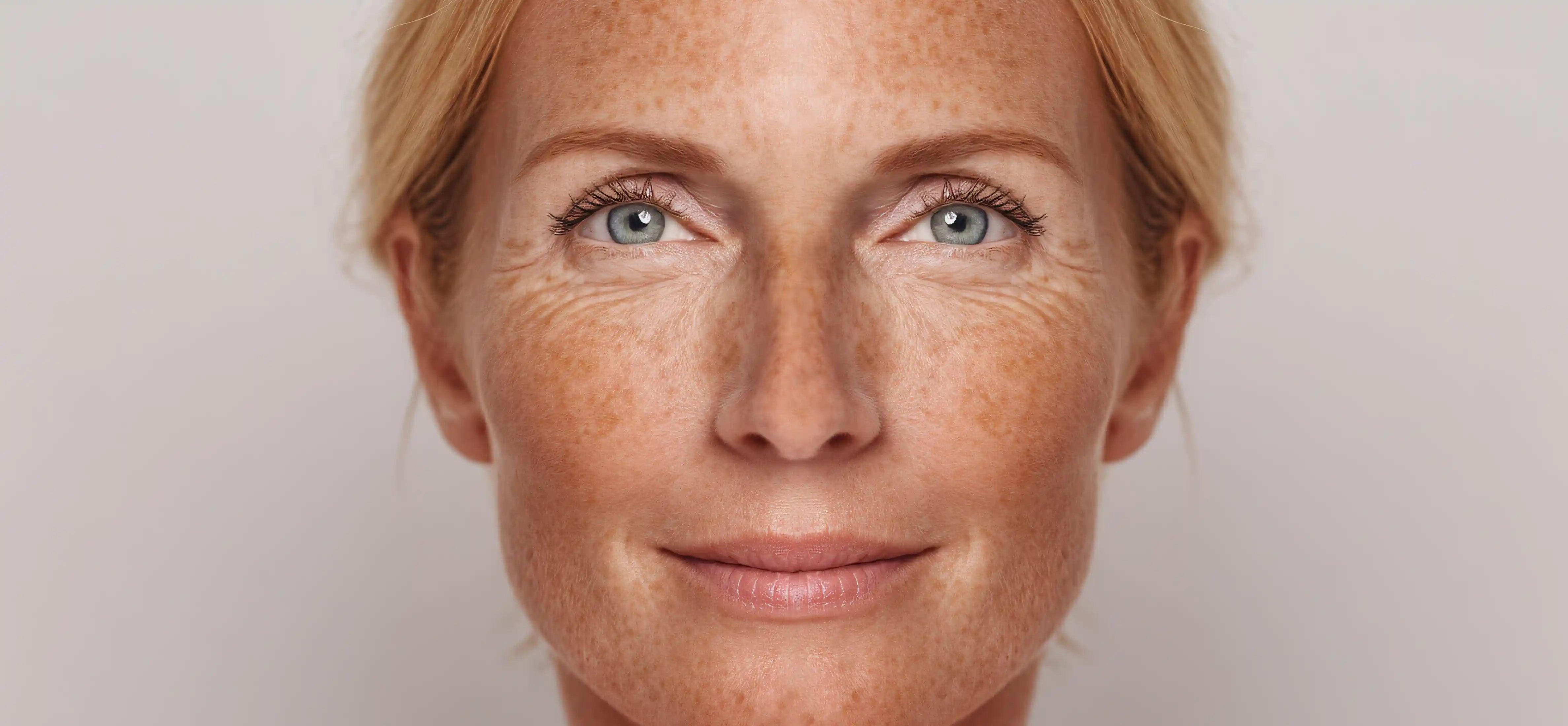 Science-backed skincare ingredients best sunscreen for melasma and hyperpigmentation SPF on the market